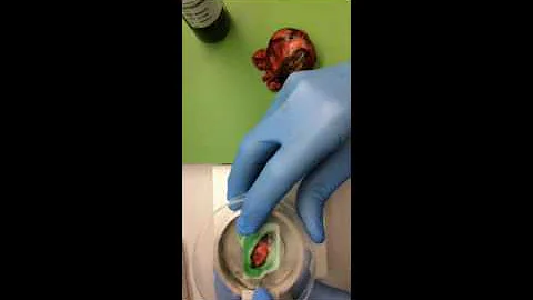 Using Mohs technique for Neurovascular bundle frozen sections in Radical prostatectomies