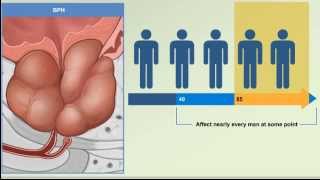 Prostate Enlargement: Benign Prostatic Hyperplasia - BPH Causes, Symptoms, Treatment Animation Video