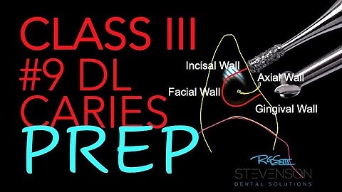 Class III Composite Preparation #9 DL Preparation