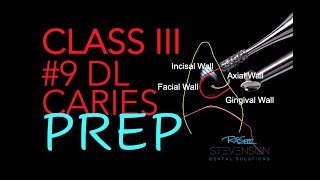 Class III Composite Preparation #9 DL Preparation