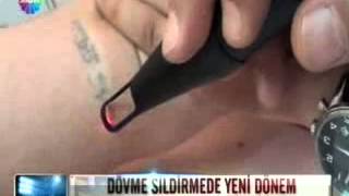 Bison Lazerli dövme silme-Estetiktrend medikal lazer cihazlar-Özgür İnal