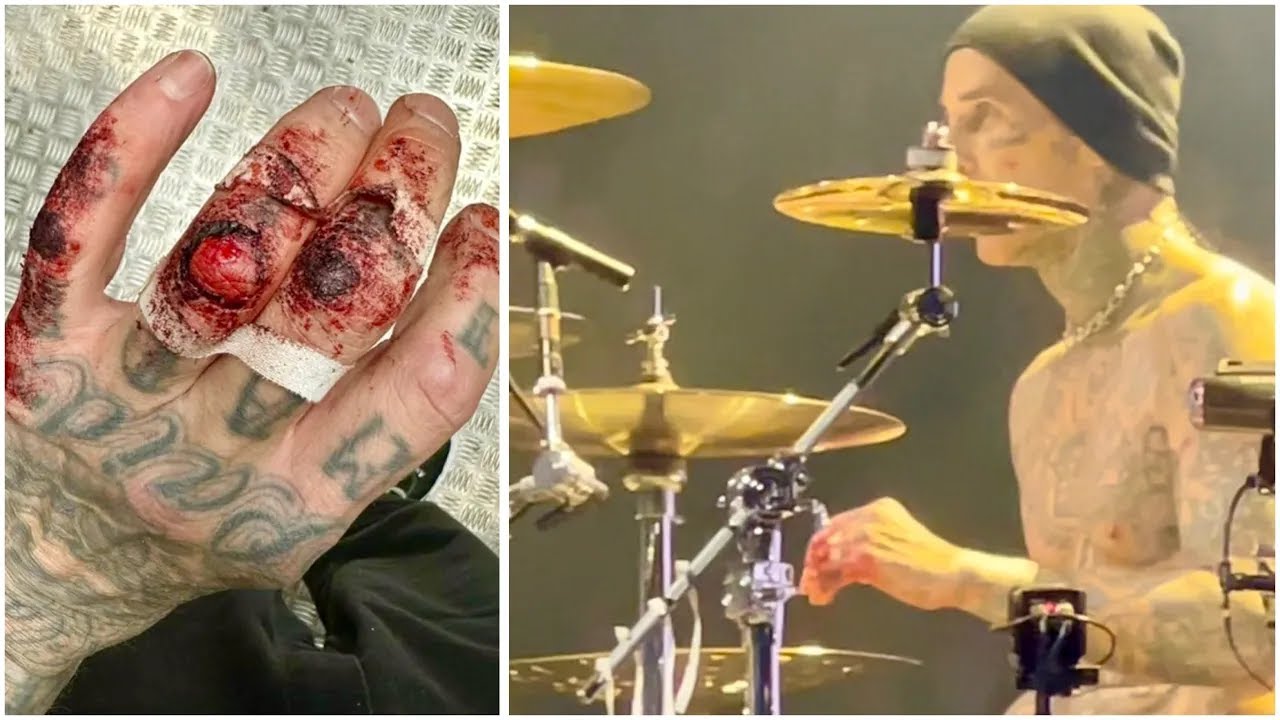 ⁣Travis Barker Drumming Injury - Blink-182