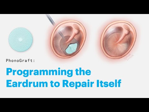 Vídeo: Eardrum Repair: Tipos, Complicações E Taxas De Sucesso