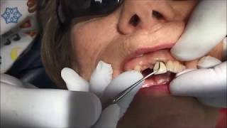 Discoloured Tooth Root Masking