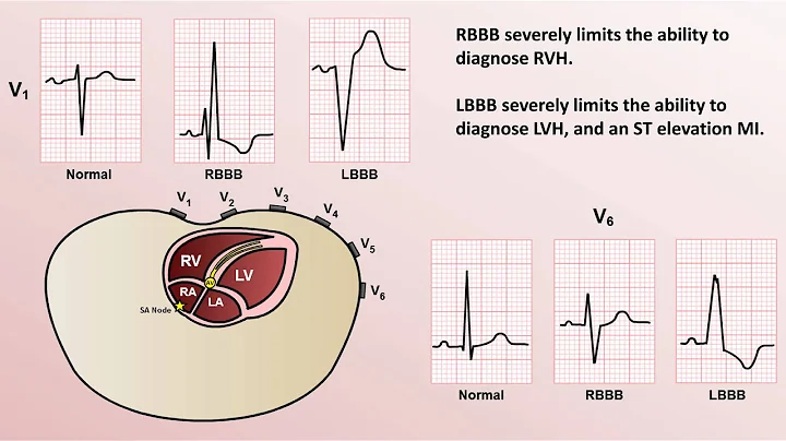 Intro to EKG Interpretation - Bundle Branch Blocks
