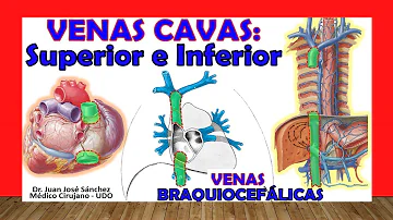 ¿Qué pasa si falla la vena cava inferior?