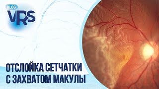 видео: Отслойка сетчатки с захватом макулы картинка: Отслойка сетчатки с захватом макулы