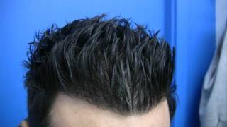 Dense Packing Hair Transplant