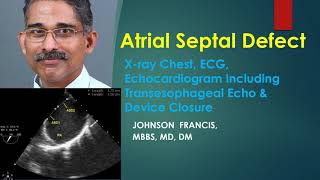 Atrial Septal Defect X-Ray, Ecg, Echo, Tee, Device Closure