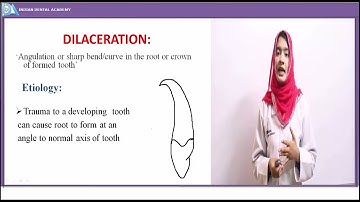Developmental disturbance of teeth part 1 #HAAD#DHA#INDIANDENTALACADEMY