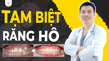 Tạm Biệt Răng Hô Sau 2 Năm Niềng Răng Mắc Cài Tại Bác sĩ Trung Long Biên