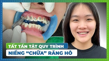 30 Triệu Niềng Răng Chữa Răng Hô Chìa