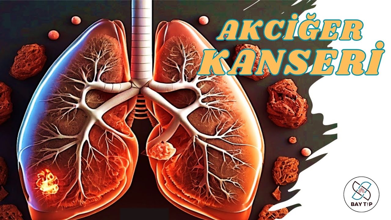 AKCİĞER KANSERİ - TIBBİ SOHBETLER-3
