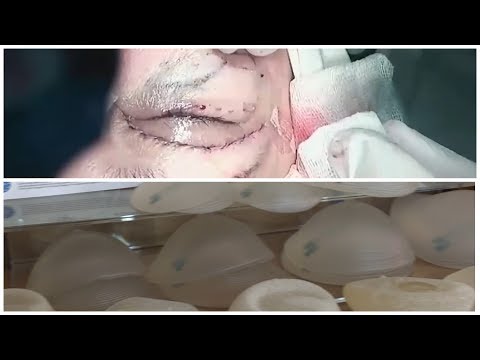 Video: Пластикалык операциядан кийин таанылгыс актрисалар