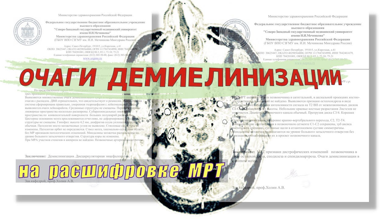 ОЧАГИ ДЕМИЕЛИНИЗАЦИИ в спинном мозге и ДИСЦИРКУЛЯТОРНАЯ ЭНЦЕФАЛОПАТИЯ на расшифровке МРТ мозга и шеи