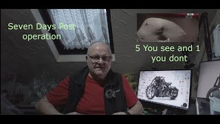 Seven Days Post Prostate Removal Operation What I have experienced so far