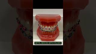 Types Of Braces  For Teeth Alignment