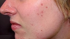 MENAKJUBKAN!! Inilah Cara Menghilangkan Bintik Merah Bekas Jerawat - Durasi: 5.11. MENAKJUBKAN!! Inilah Cara Menghilangkan Bintik Merah Bekas Jerawat - Durasi: 5.11.