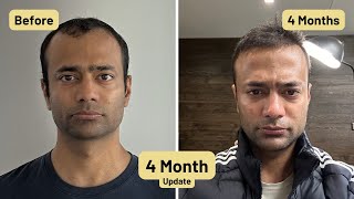 4 Month Update for Hair Transplant | 5200 grafts from Istanbul Turkey