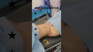 Abdominoplastia, liposucción de espalda y cintura, técnica RibXcar y transferencia de grasa (BBL)