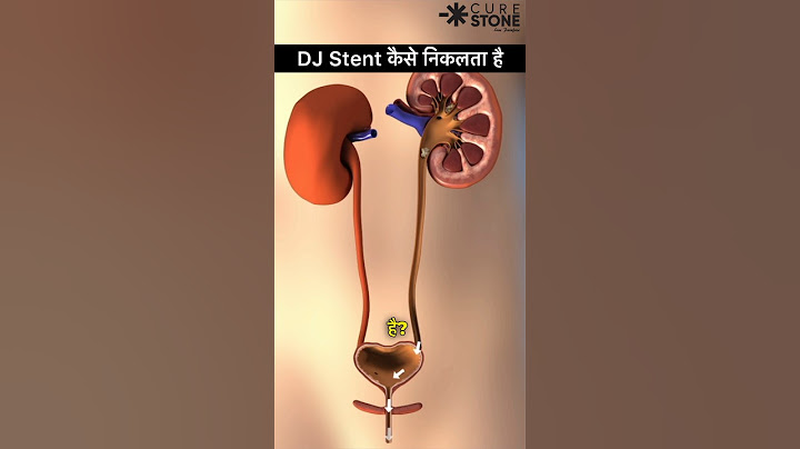 DJ Stent Removal | Retrograde Intrarenal Surgery | kidney stone treatment #shorts