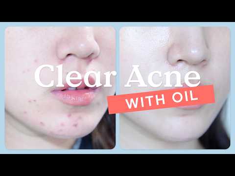 Debunking Acne Myths: How to treat acne with oils | KraveBeauty Oil La La
