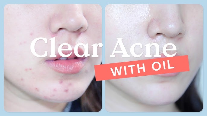 5 Ways To Busting Acne Myths Treating With 2024
