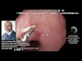 Endoscopy procedure for foreign body removal