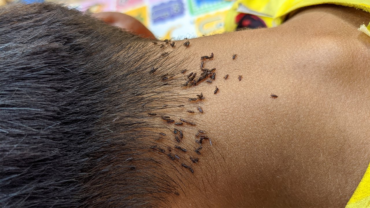 Remove hundred lice from her black hair - Pick out all ...