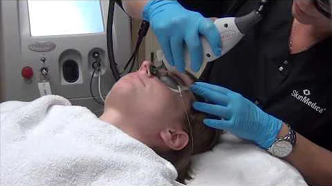VBeam - Lafayette, LA - Dr. Cynthia Glass