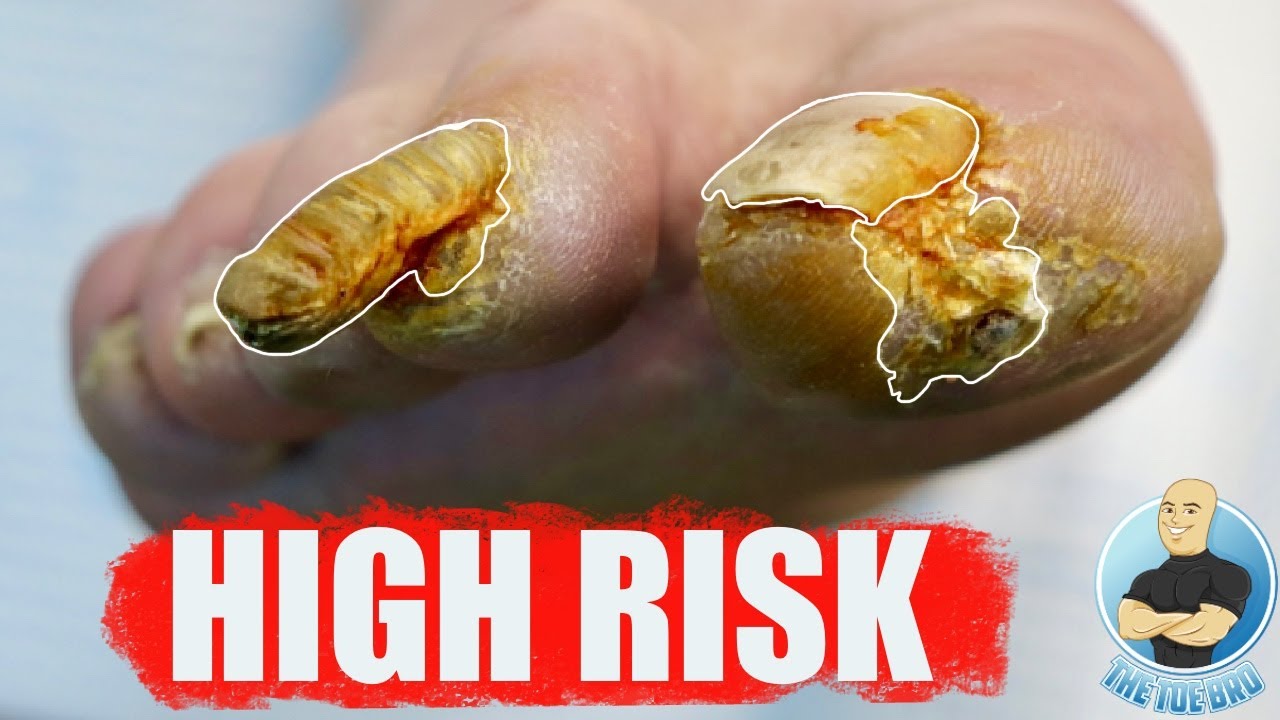 ⁣EXTREMELY HIGH RISK NAIL CUTTING OF SUPER THICK TOENAIL!!!