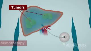 Hepatic Artery Infusion (HAI) Pump Chemotherapy for Liver Metastases
