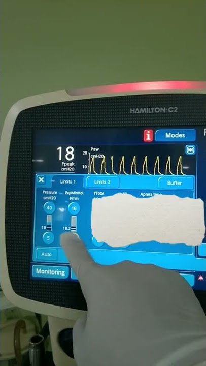 Cara Mengatur Ulang Alarm pada Ventilator Hamilton C2