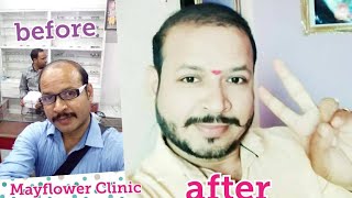 Hair transplant surgery, हेयर ट्रांसप्लांट सर्जरी,  review and cost, Nagpur