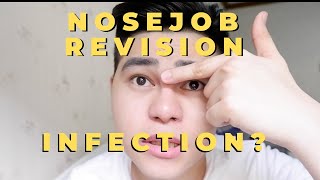 NOSEJOB REVISION FROM SILICONE TO GORETEX TO SILICONE AGAIN | MY RHINOPLASTY EXPERIENCE (20152019)