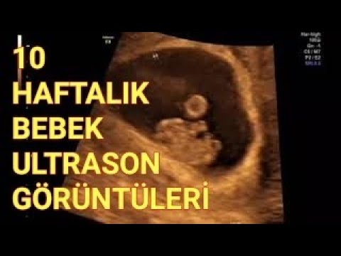anne karnindaki bebek 10 haftada aciklamali ultrason goruntuleri youtube