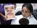 Cleft Rhinoplasty: Consultation and Post-Op  - Dr. Sunil Richardson | Richardsons Face Hospitals