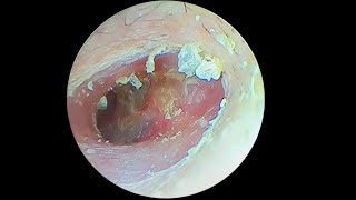 采耳哥-Cleaning of fungal smears from the ear canal and eardrum ｜744