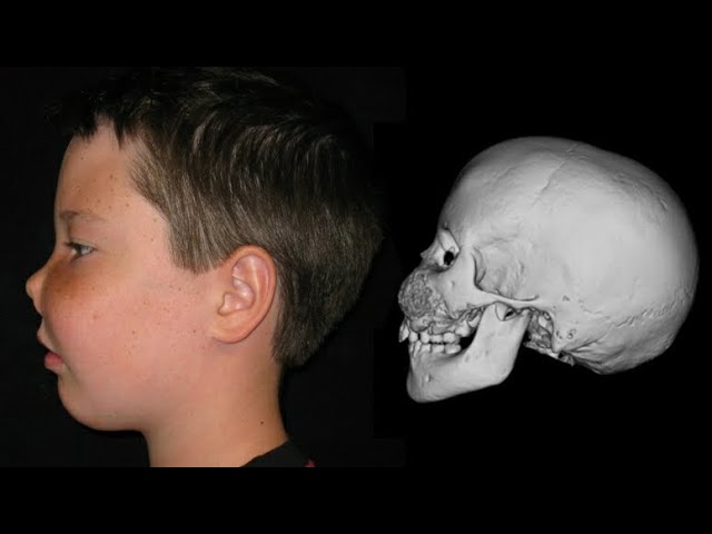 ФИБРОЗНОЙ ОСТЕОДИСПЛАЗИИ ЛОБНОЙ КОСТИ