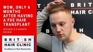 MICHAEL, 27 FUE TREATMENT 6 MONTH REVEIW AT THE BRITISH HAIR CLINIC