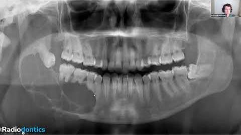 RAY Webinar with Dr. Andreasen Oct. 23, 2025