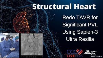 Redo TAVR for Significant PVL Using Sapien-3 Ultra Resilia