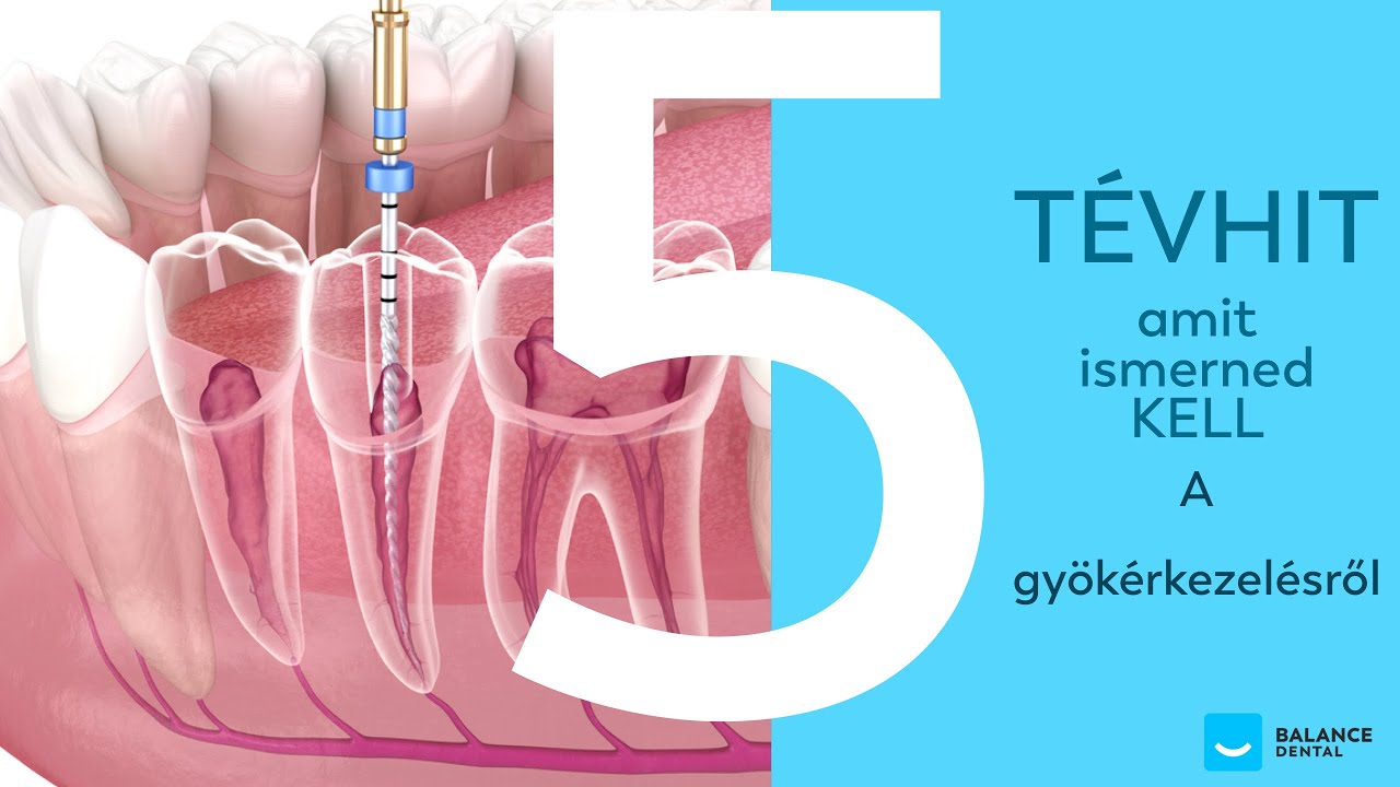 Gyökérkezelés - 5 Tévhit aminek nem szabad bedőlnöd!