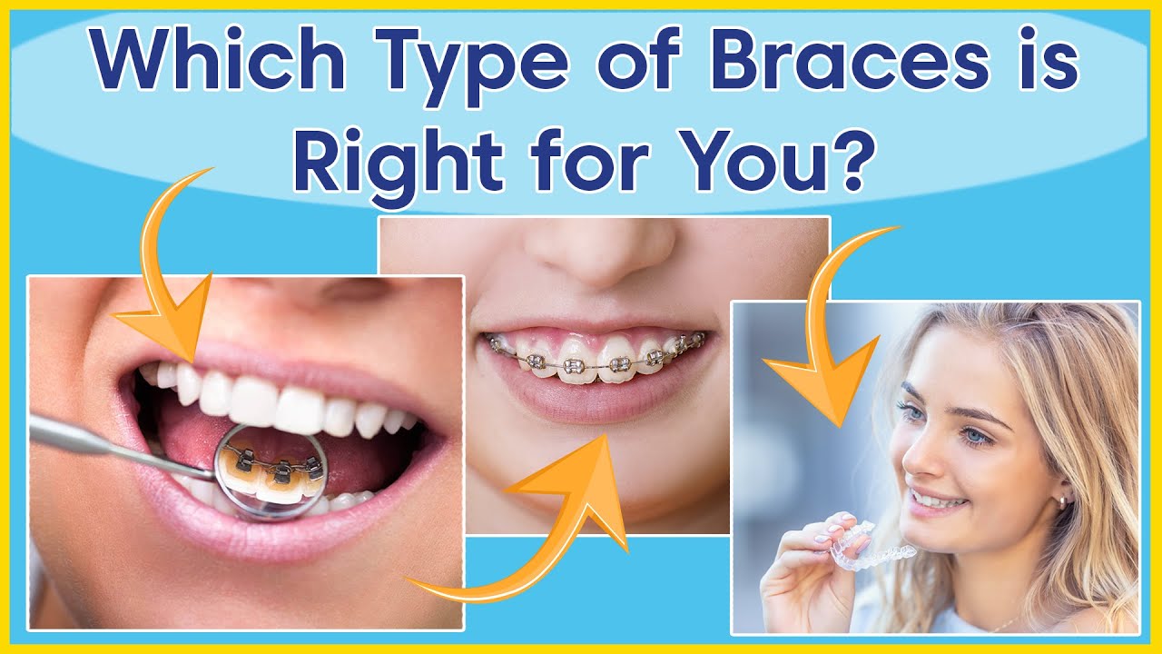 Types Of Orthodontic Treatment | Which Braces Are Right For You? - YouTube