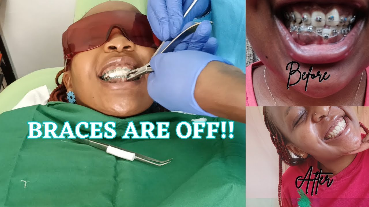 BRACES BEFORE AND AFTER the experience + a few days afterKenyan