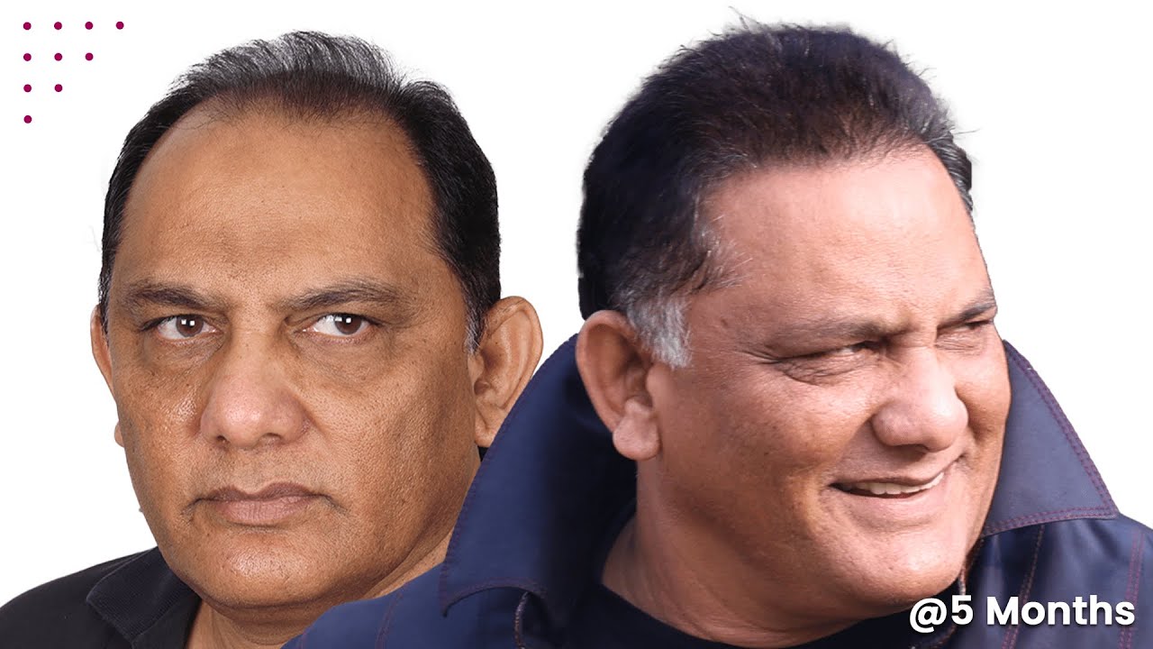 Celebrity Favors Hair Transplant ft. Mohammad Azharuddin | After 5 Months | Hair Transplant Results
