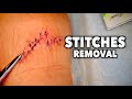 REMOVING 13 STITCHES (From a Huge Leg Wound) | Dr. Paul