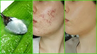 This face mask takes of all your dead skin, makeup, and bacteria in
seconds! that's why i love to use diy aloe vera exfoliating mask. it's
natural,...