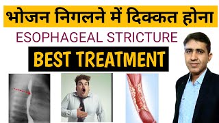 खाना निगलने में दिक्कत होना | भोजन नली में सिकुडन | Esophageal Stricture Homeopathy Medicine | Hindi screenshot 5