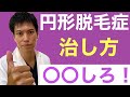 【円形脱毛症①】その円形脱毛症が○○すると治るって知ってた？最新治療法から今の治療法の欠点まですべてを解説